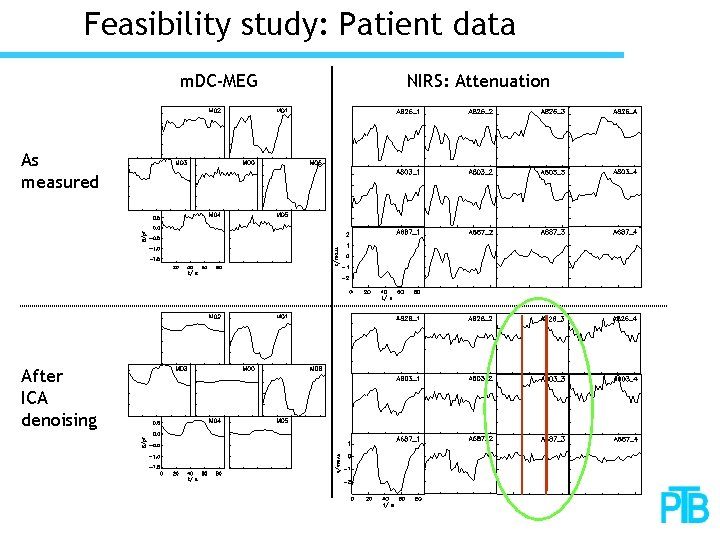 Feasibility study: Patient data m. DC-MEG As measured After ICA denoising NIRS: Attenuation 