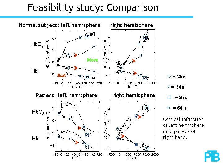 Feasibility study: Comparison Normal subject: left hemisphere right hemisphere Hb. O 2 Hb Patient: