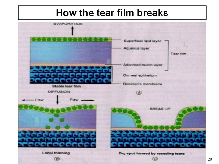 How the tear film breaks 20 