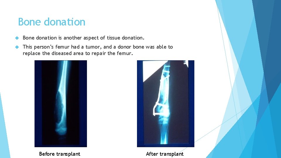 Bone donation is another aspect of tissue donation. This person’s femur had a tumor,