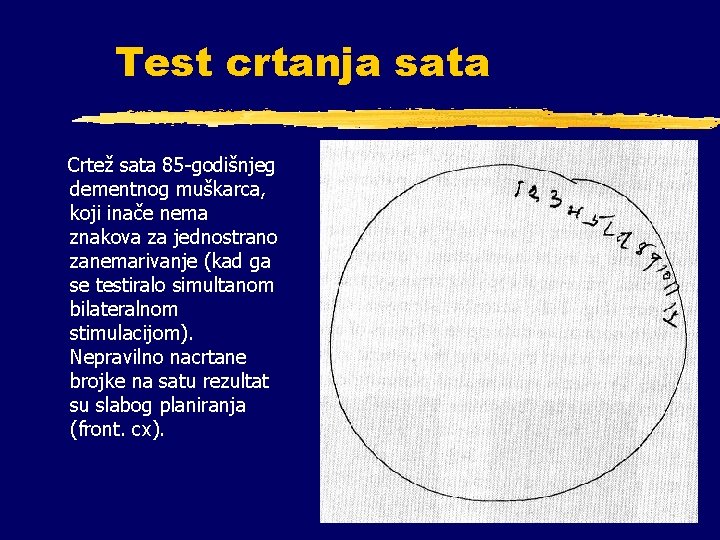 Test crtanja sata Crtež sata 85 -godišnjeg dementnog muškarca, koji inače nema znakova za