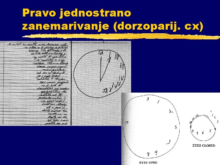 Pravo jednostrano zanemarivanje (dorzoparij. cx) 