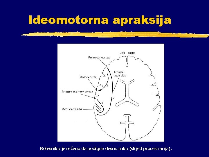 Ideomotorna apraksija Bolesniku je rečeno da podigne desnu ruku (slijed procesiranja). 