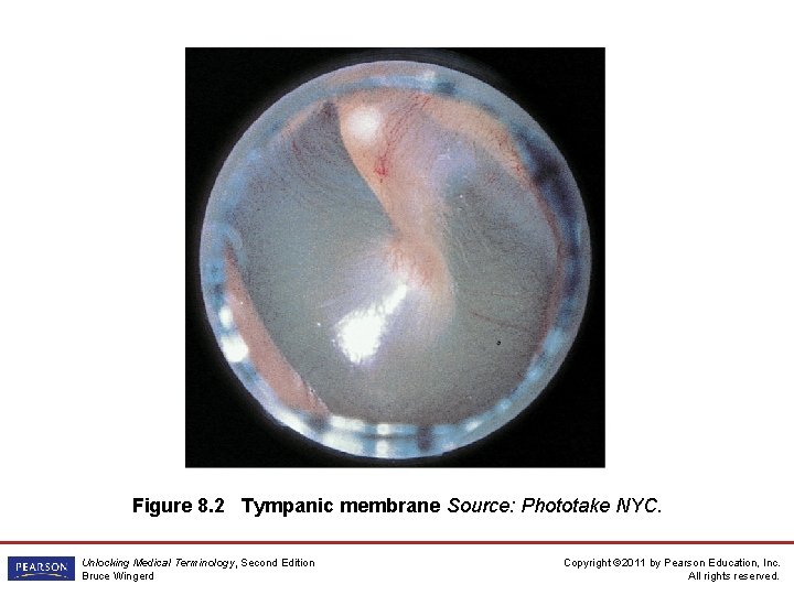 Figure 8. 2 Tympanic membrane Source: Phototake NYC. Unlocking Medical Terminology, Second Edition Bruce