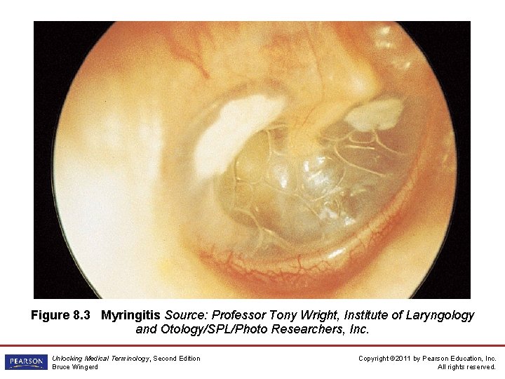 Figure 8. 3 Myringitis Source: Professor Tony Wright, Institute of Laryngology and Otology/SPL/Photo Researchers,