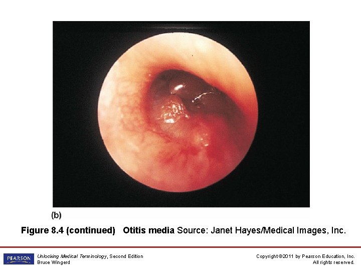 Figure 8. 4 (continued) Otitis media Source: Janet Hayes/Medical Images, Inc. Unlocking Medical Terminology,