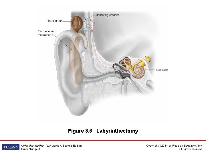 Figure 8. 6 Labyrinthectomy Unlocking Medical Terminology, Second Edition Bruce Wingerd Copyright © 2011