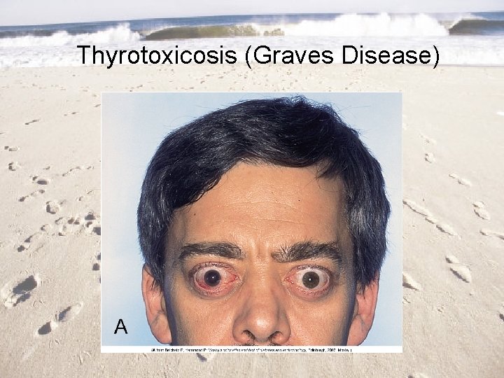 Thyrotoxicosis (Graves Disease) 