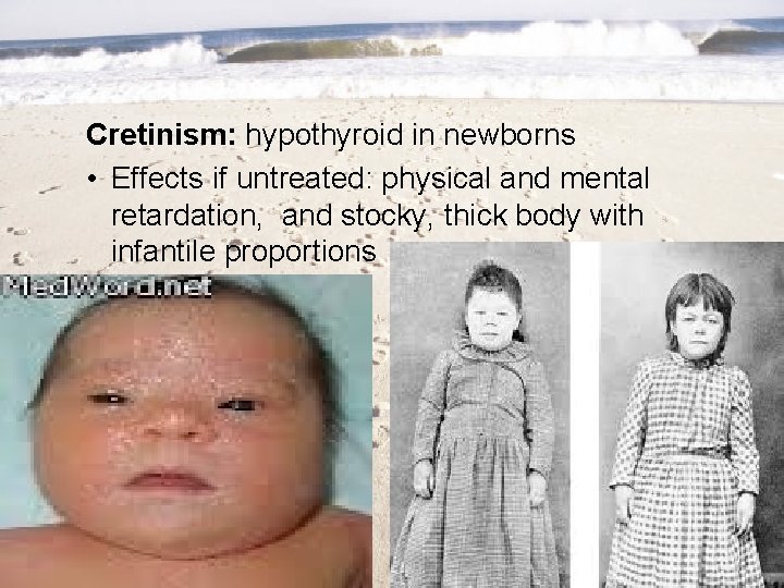 Cretinism: hypothyroid in newborns • Effects if untreated: physical and mental retardation, and stocky,