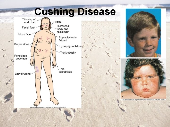 Cushing Disease 