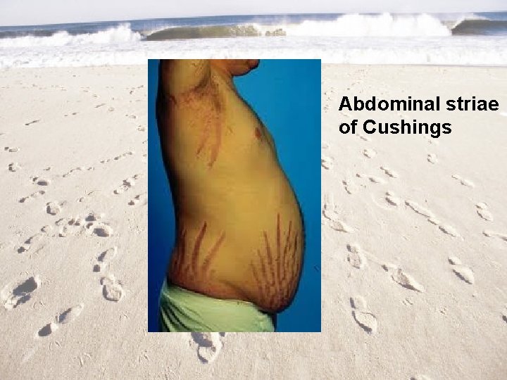 Abdominal striae of Cushings 