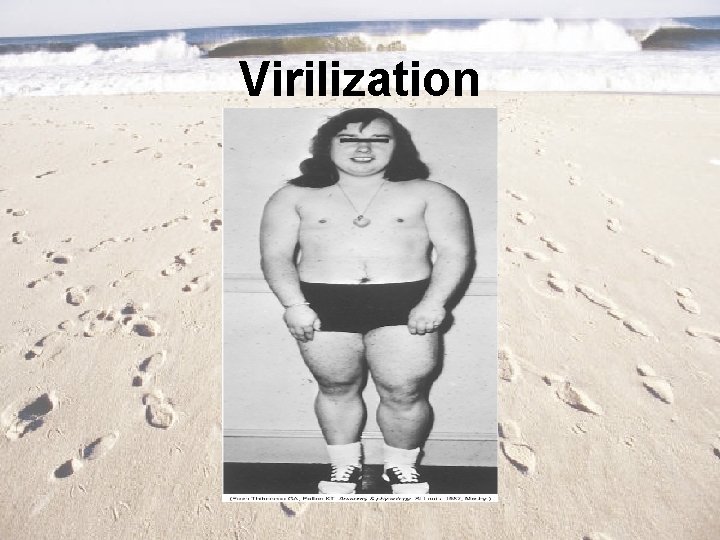 Virilization 