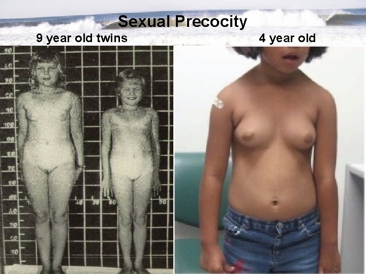 Sexual Precocity 9 year old twins 4 year old 