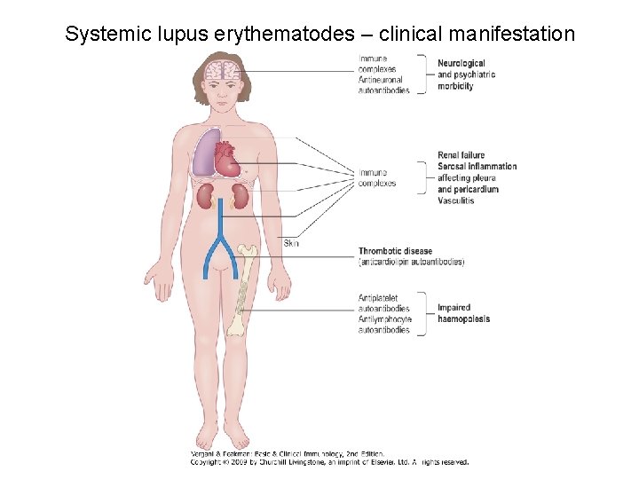 Systemic lupus erythematodes – clinical manifestation 