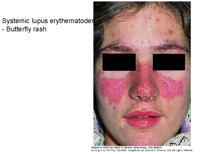 Systemic lupus erythematodes - Butterfly rash 