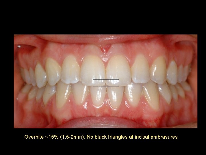 Overbite ~15% (1. 5 -2 mm), No black triangles at incisal embrasures 