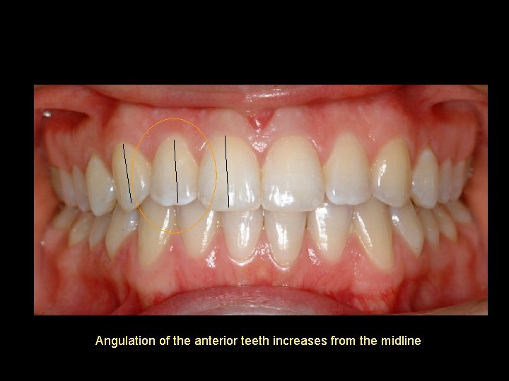 Angulation of the anterior teeth increases from the midline 