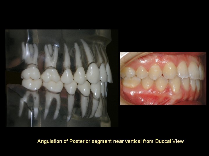 Angulation of Posterior segment near vertical from Buccal View 