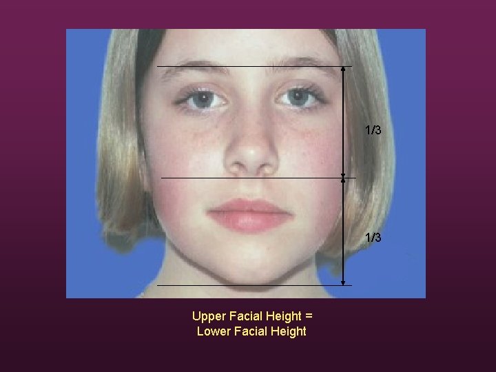 1/3 Upper Facial Height = Lower Facial Height 