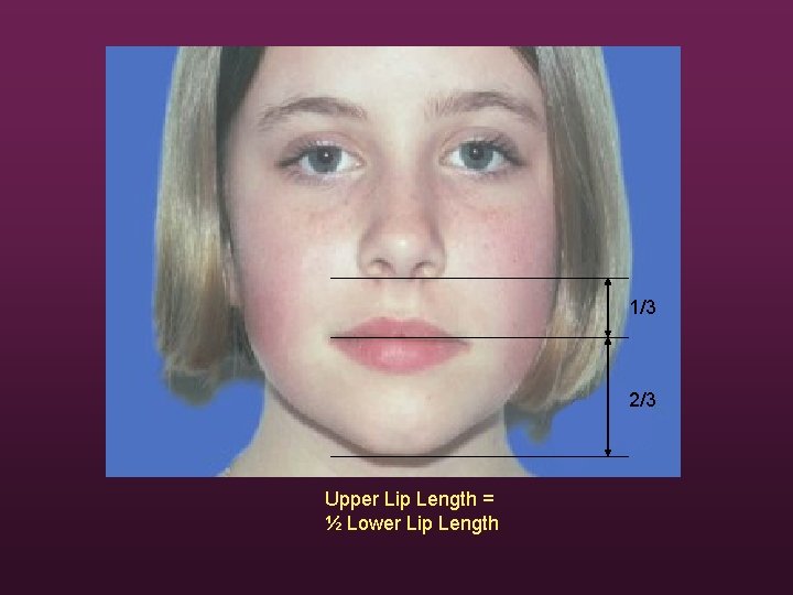 1/3 2/3 Upper Lip Length = ½ Lower Lip Length 