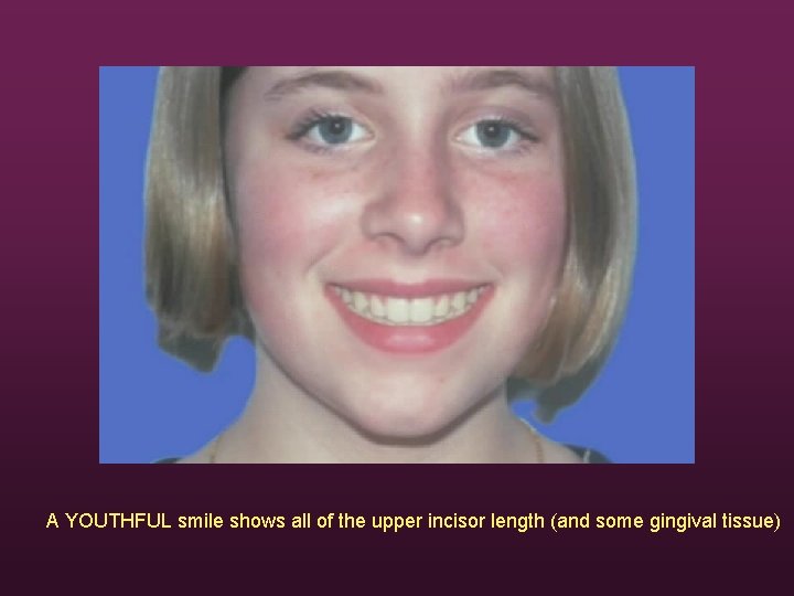 A YOUTHFUL smile shows all of the upper incisor length (and some gingival tissue)