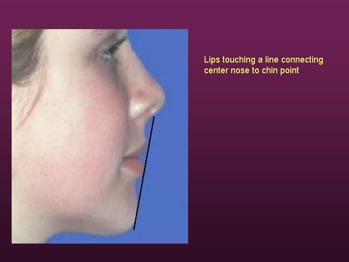 Lips touching a line connecting center nose to chin point 