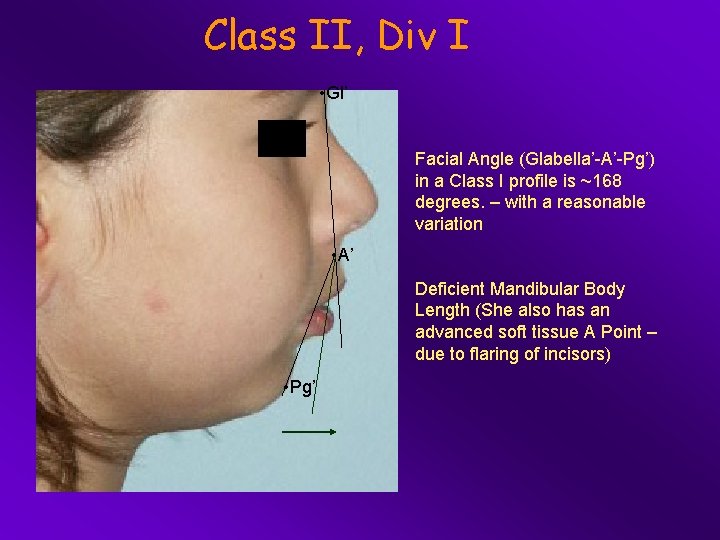 Class II, Div I • Gl’ Facial Angle (Glabella’-A’-Pg’) in a Class I profile