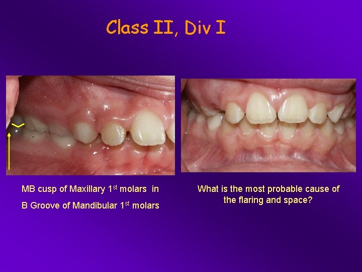 Class II, Div I MB cusp of Maxillary 1 st molars in B Groove