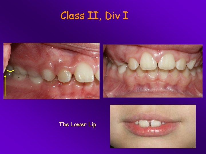 Class II, Div I The Lower Lip 