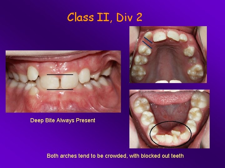 Class II, Div 2 Deep Bite Always Present Both arches tend to be crowded,