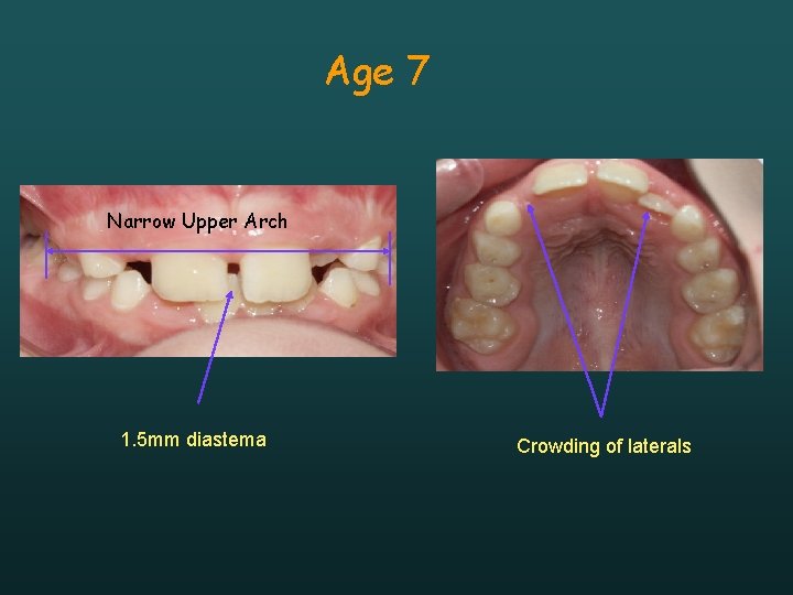 Age 7 Narrow Upper Arch 1. 5 mm diastema Crowding of laterals 
