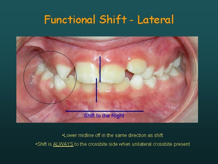 Functional Shift - Lateral Shift to the Right • Lower midline off in the