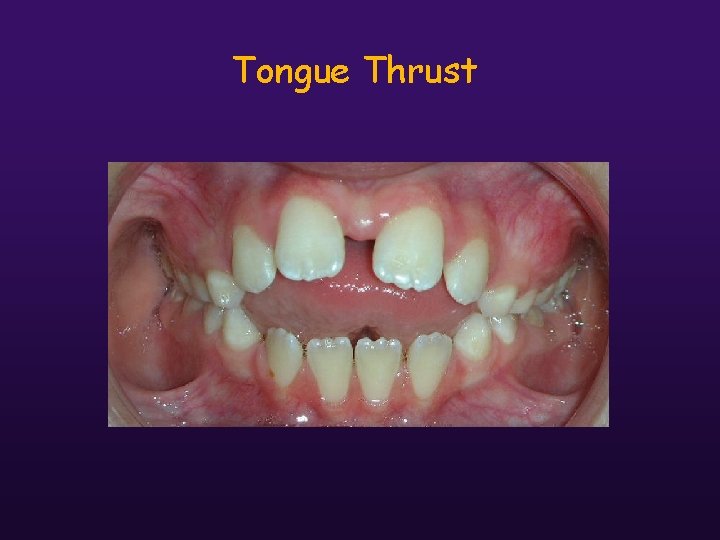 Tongue Thrust 