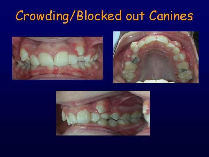 Crowding/Blocked out Canines 