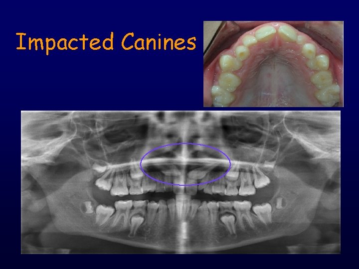 Impacted Canines 