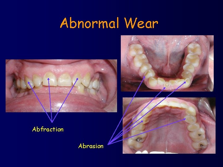 Abnormal Wear Abfraction Abrasion 