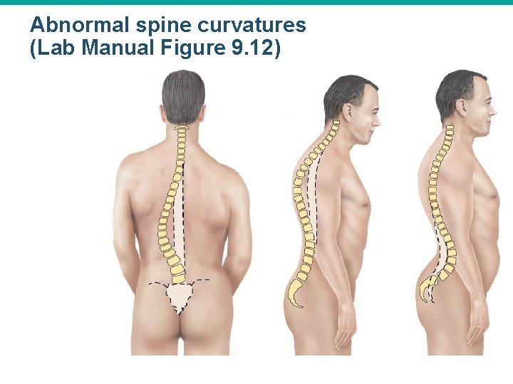 Abnormal spine curvatures (Lab Manual Figure 9. 12) 