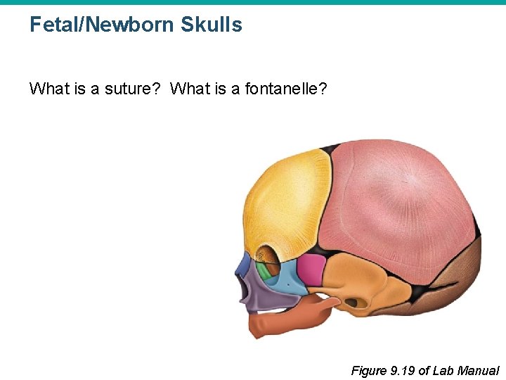 Fetal/Newborn Skulls What is a suture? What is a fontanelle? Figure 9. 19 of