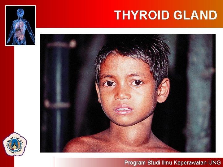 THYROID GLAND Program Studi Ilmu Keperawatan-UNG 