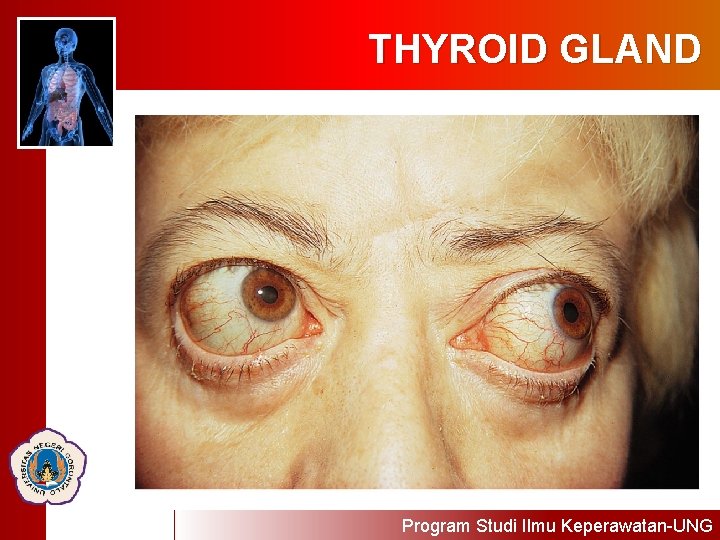THYROID GLAND Program Studi Ilmu Keperawatan-UNG 