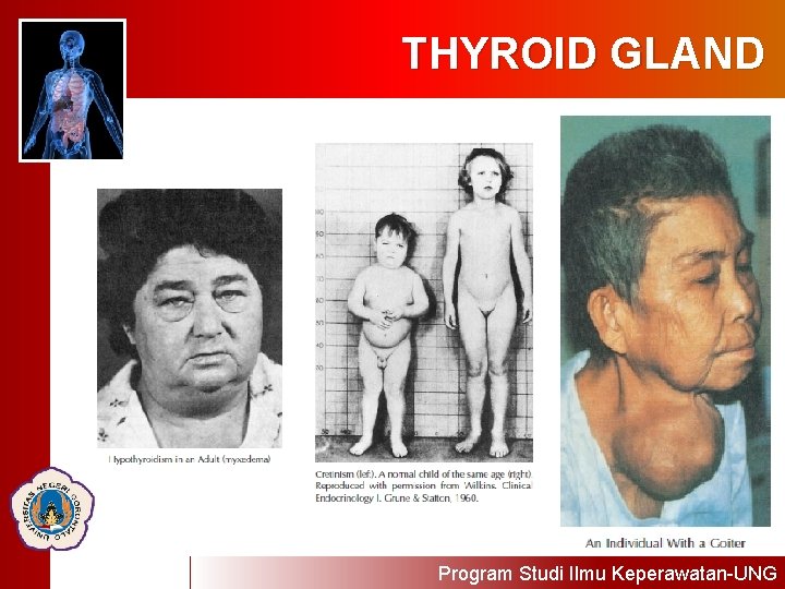 THYROID GLAND Program Studi Ilmu Keperawatan-UNG 