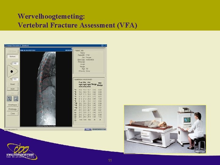 Wervelhoogtemeting: Vertebral Fracture Assessment (VFA) 11 