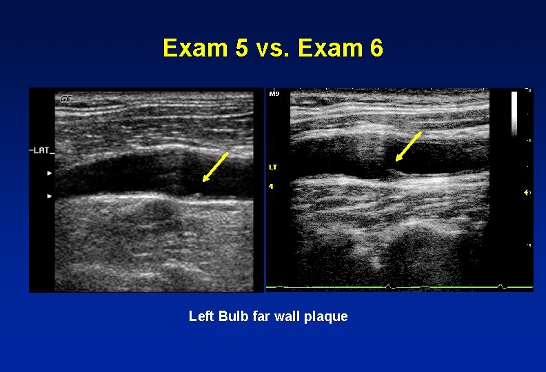 Exam 5 vs. Exam 6 Left Bulb far wall plaque 