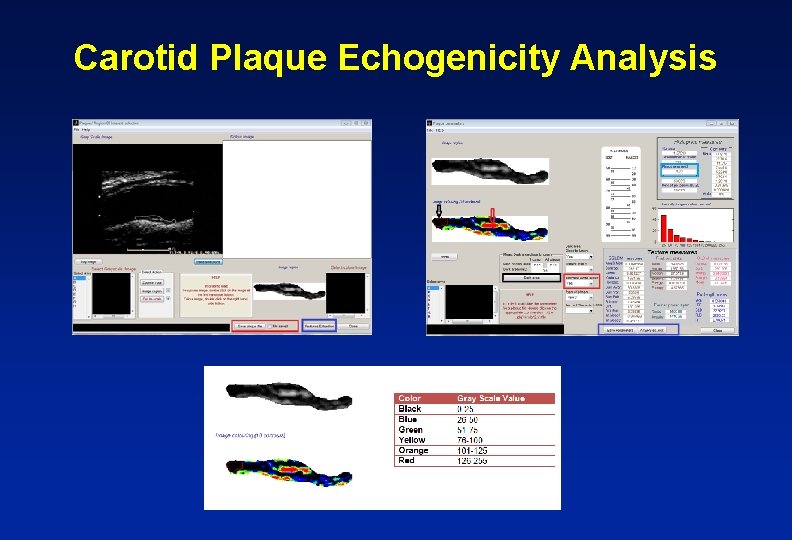 Carotid Plaque Echogenicity Analysis 