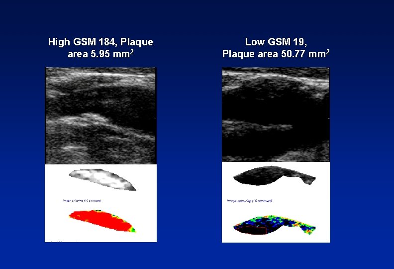 High GSM 184, Plaque area 5. 95 mm 2 Low GSM 19, Plaque area