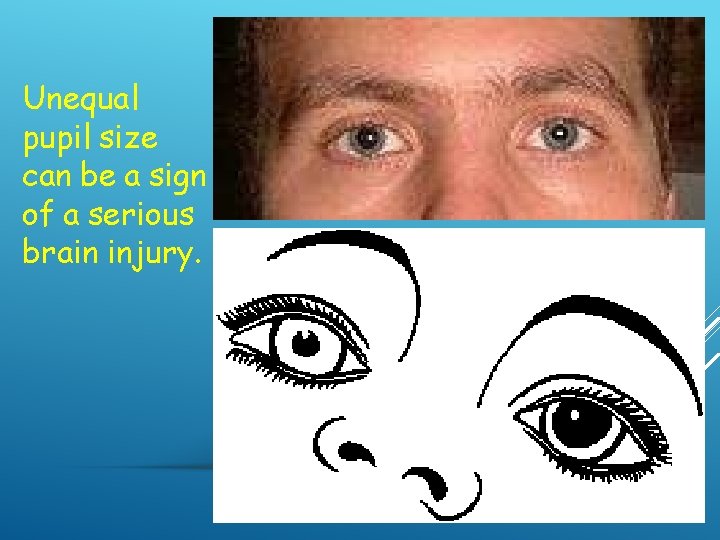 Unequal pupil size can be a sign of a serious brain injury. 