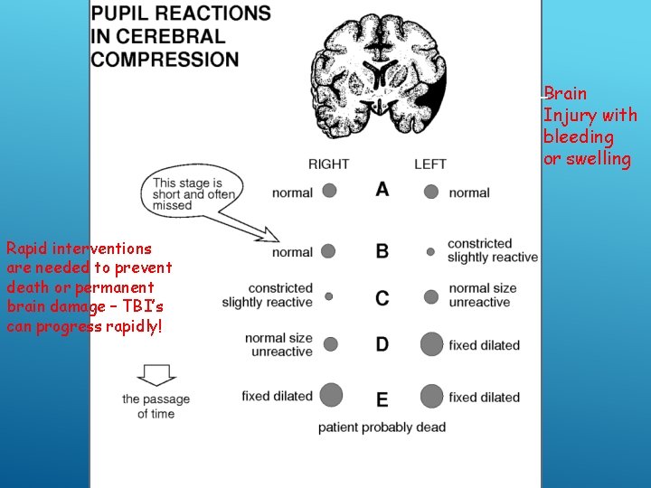 Brain Injury with bleeding or swelling Rapid interventions are needed to prevent death or