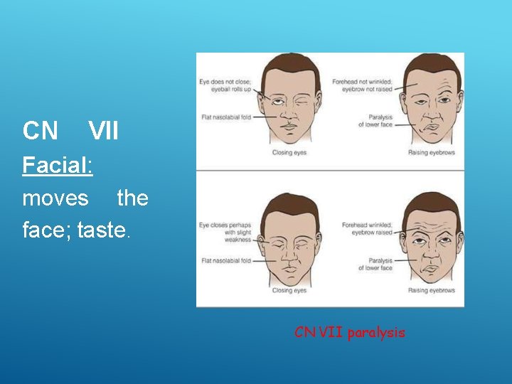 CN VII Facial: moves the face; taste. CN VII paralysis 