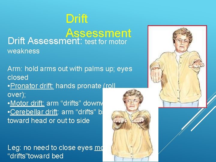 Drift Assessment: test for motor weakness Arm: hold arms out with palms up; eyes