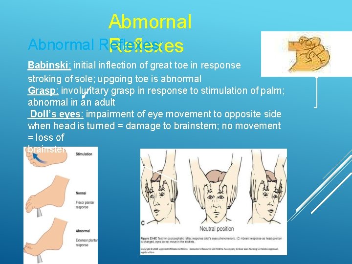 Abmornal Abnormal Reflexes: Reflexes Babinski: initial inflection of great toe in response stroking of